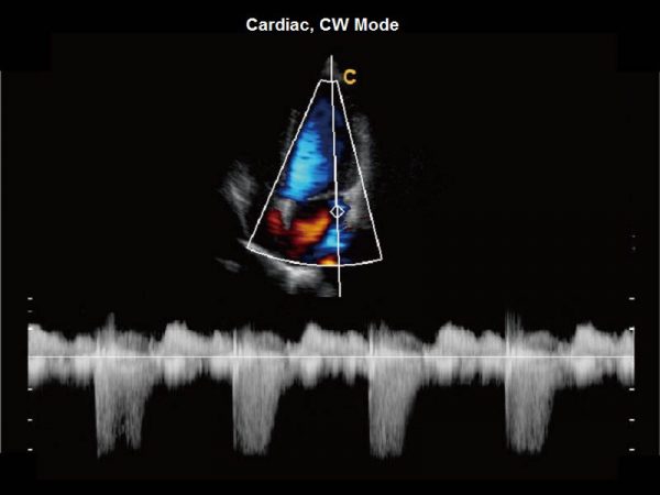 Cardiac, CW Mode
