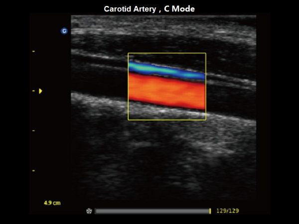 Carotid Artery，C Mode