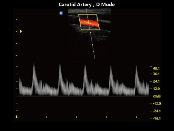 Carotid Artery，D Mode