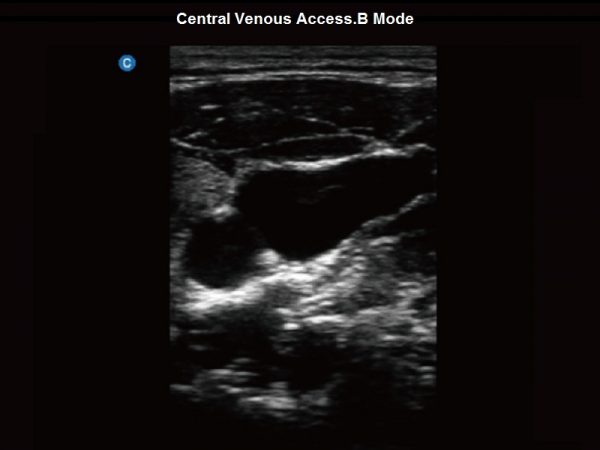 Central Venous Access.B Mode