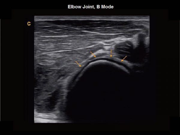 Elbow Joint, B Mode