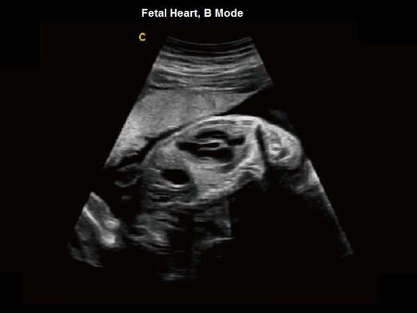 Fetal Heart, B Mode