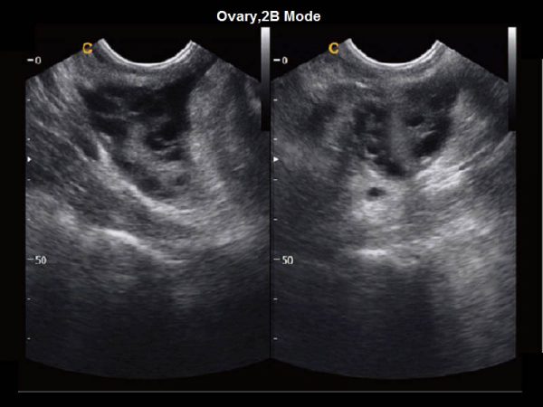 Ovary,2B Mode