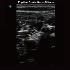 Popliteal Sciatic Nerve,B Mode