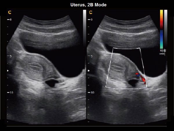 Uterus, 2B Mode