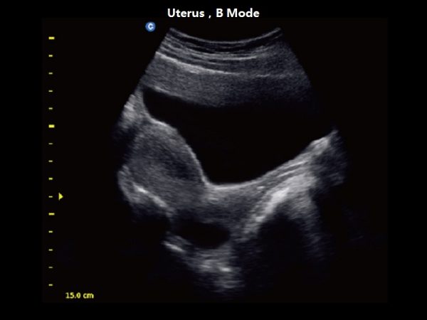 Uterus，B Mode